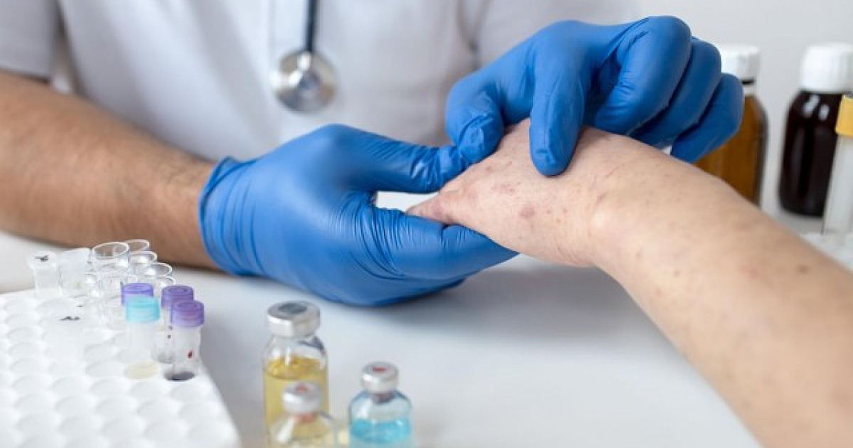 Em uma semana, Barueri tem alta de 50% dos casos de Monkeypox