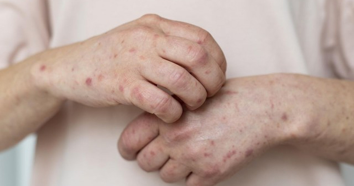 Santana de Parnaíba registra os primeiros casos de Monkeypox