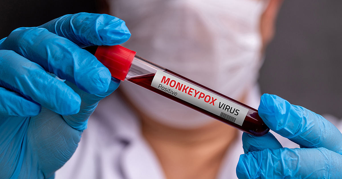 Com novos casos, especialista faz alerta em relação à Mpox
