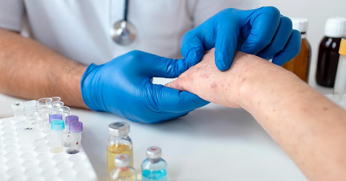 Sobe para 140 número de casos confirmados de Mpox no país